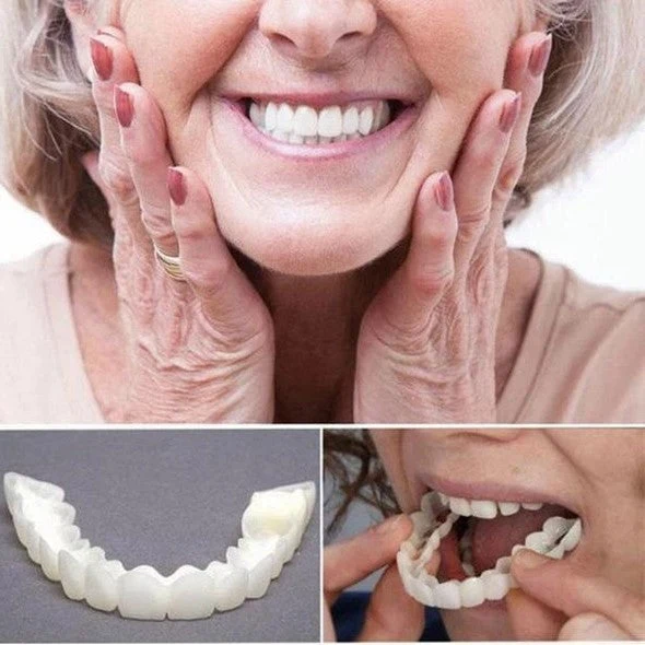 Kosmetische Veneers für Ober- und Unterkiefer