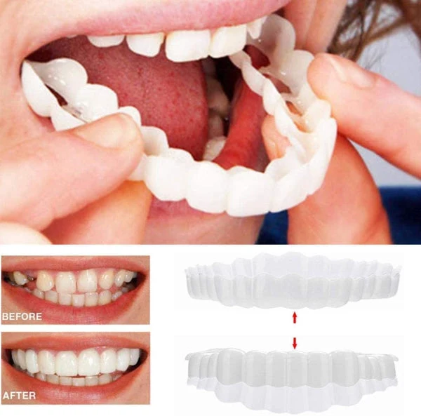 Kosmetische Veneers für Ober- und Unterkiefer